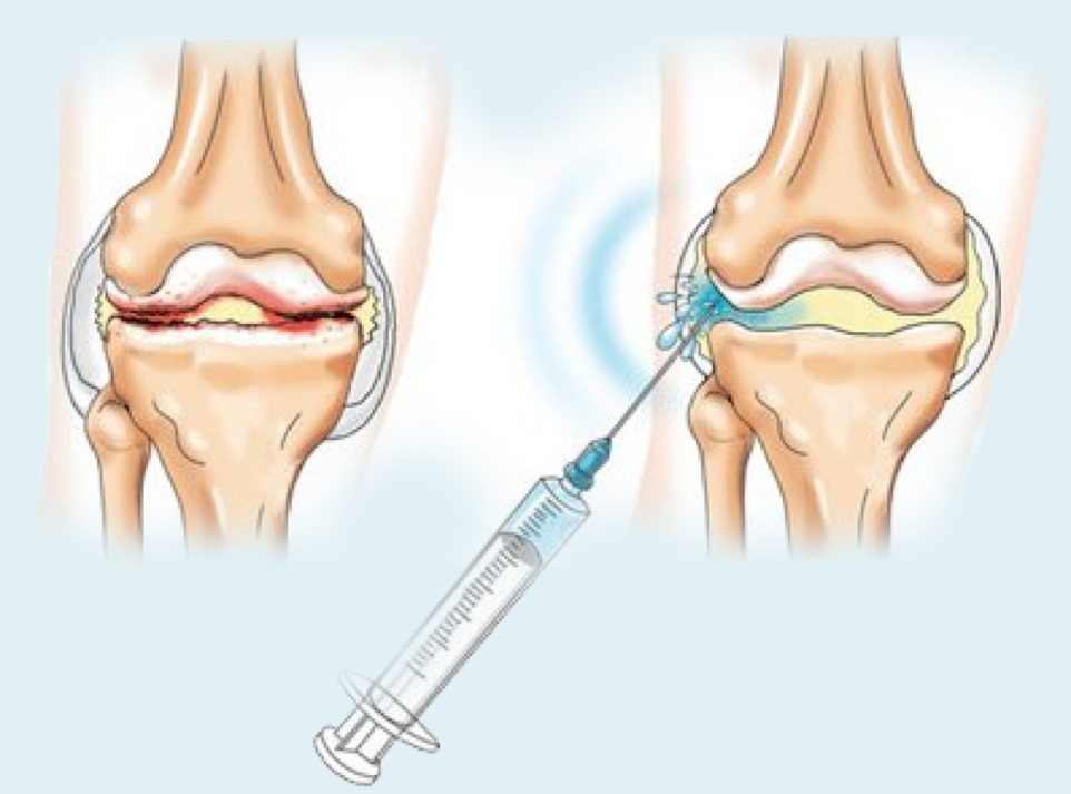 Инъекции ГК в сустав.png